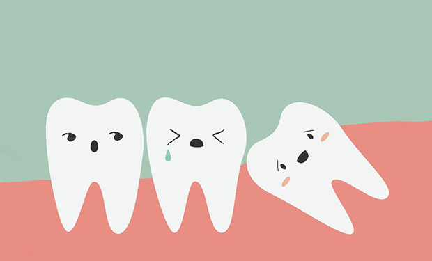 Dente del giudizio: quando toglierlo e cosa aspettarsi dopo l’estrazione