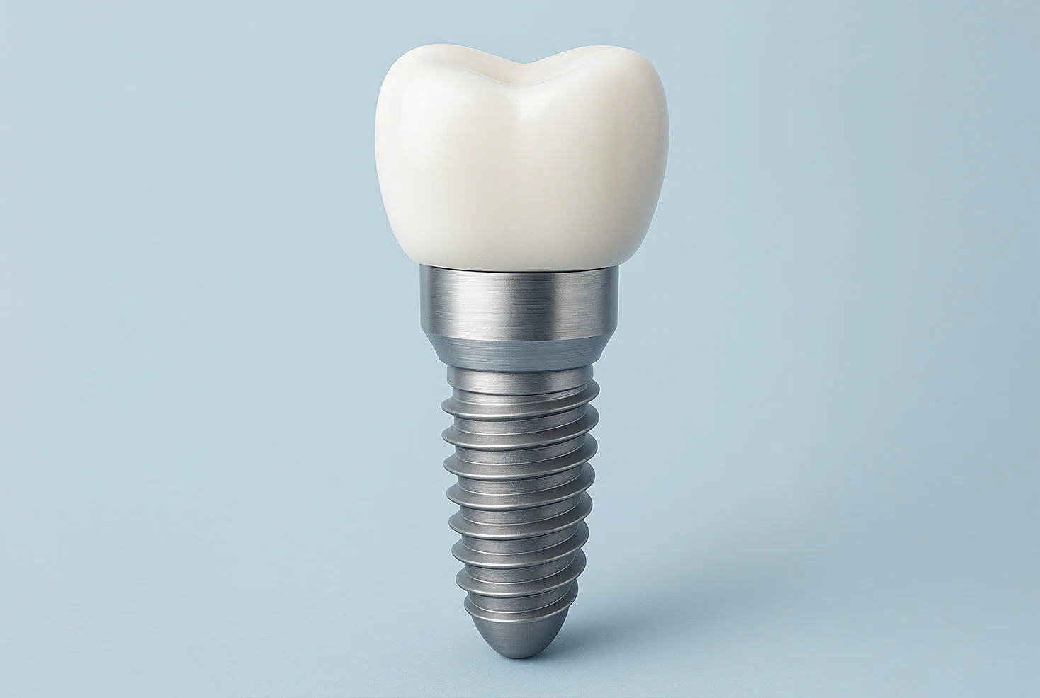 Impianti dentali: la soluzione per sostituire i denti mancanti